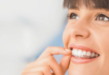 Исправление прикуса элайнерами: современный путь к идеальной улыбке